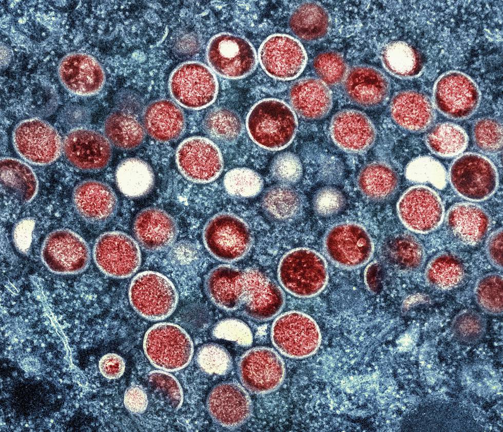 Bildet viser nærbildet av celler som er smittet. En mann har fått påvist apekopper i Indre Østfold. Hittil er det meldt inn 51 smittetilfeller av apekopper i Norge.